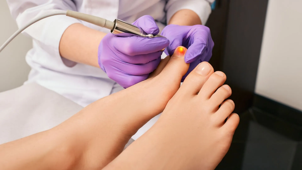 Laserterapia para Onicomicose: Como Funciona e Quantas Sessões?