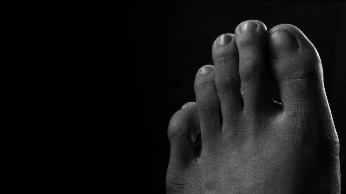 Micose de Unha (Onicomicose): Causas, Tratamento e Prevenção