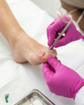 Onicocriptose (unha encravada com infecção)